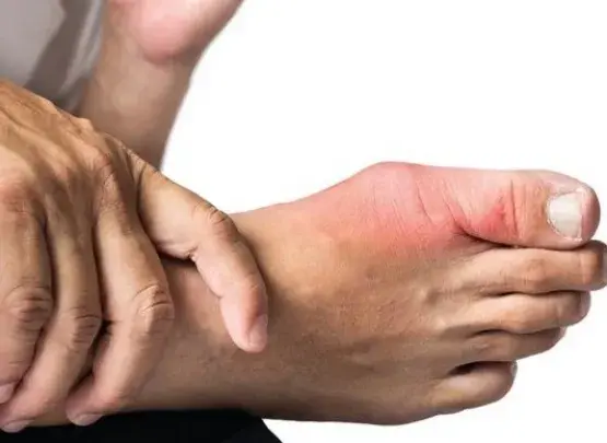 Como tratar gota no paciente com DRC?